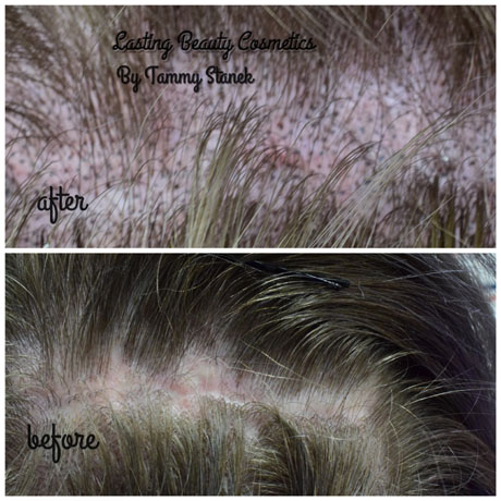Hair Pigmentation to camouflage a scar